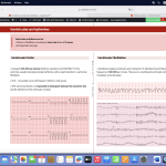 Arrhythmia, Flutters and Fibrillations